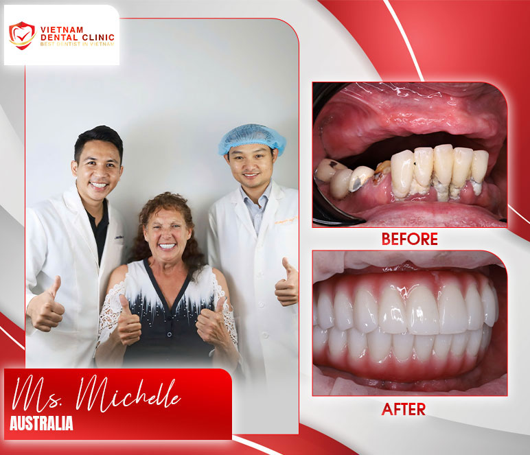 vietnam dental clinic before after dental implants 1