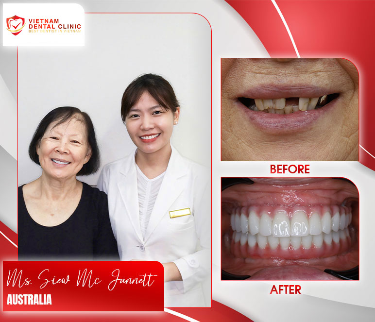 vietnam dental clinic before after dental implants 2