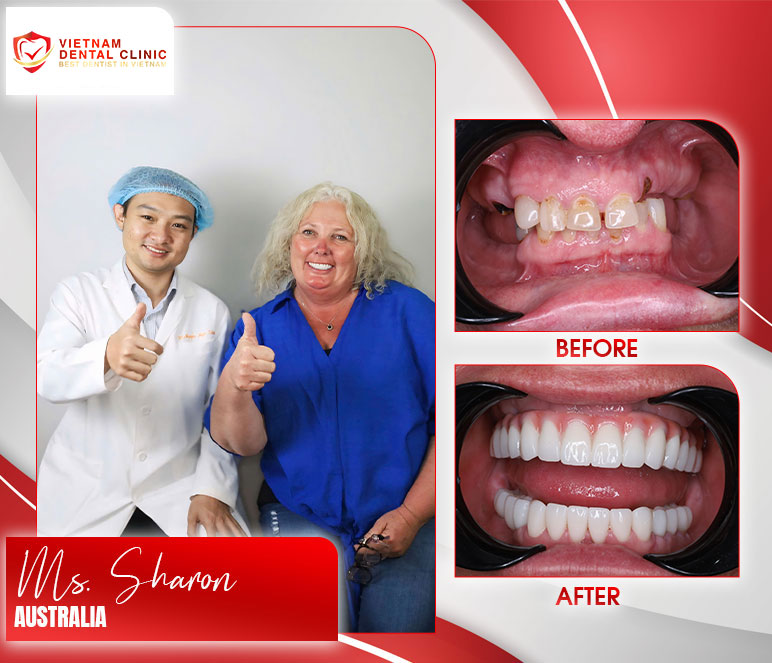 vietnam dental clinic before after dental implants
