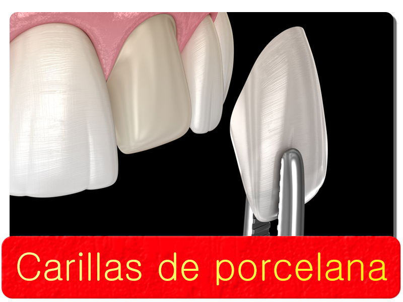 Carillas de porcelana
