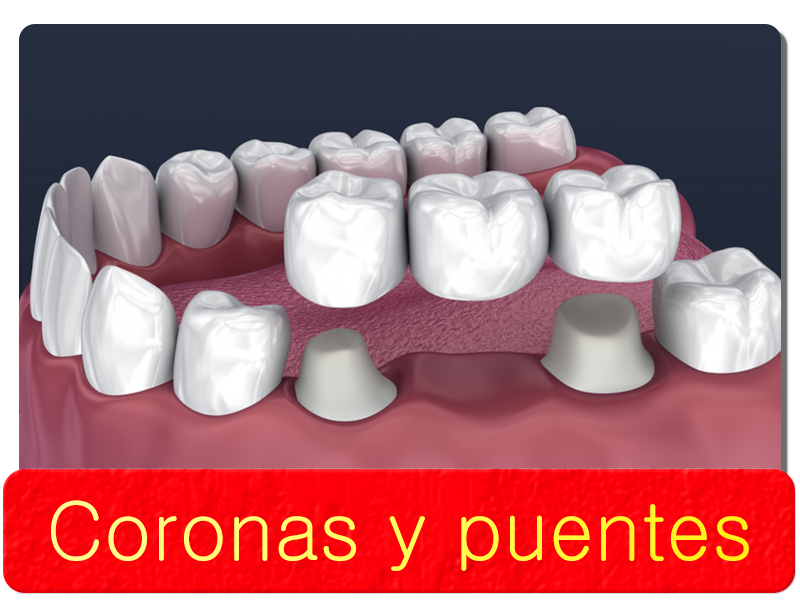 Coronas y puentes