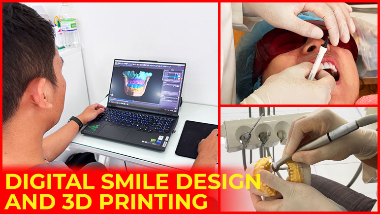 Digital smile design and 3D printing