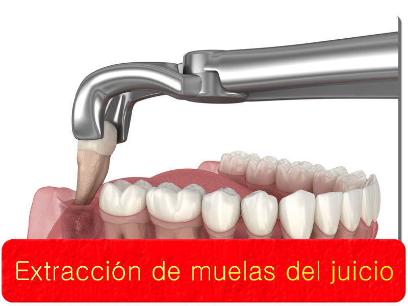 Extraccion de muelas del juicio
