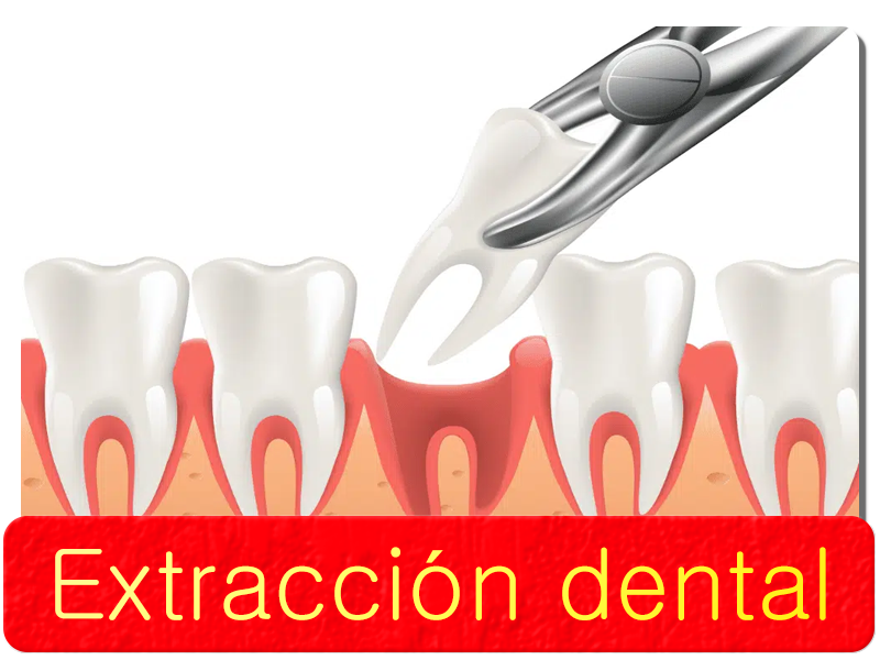 Extraccion dental