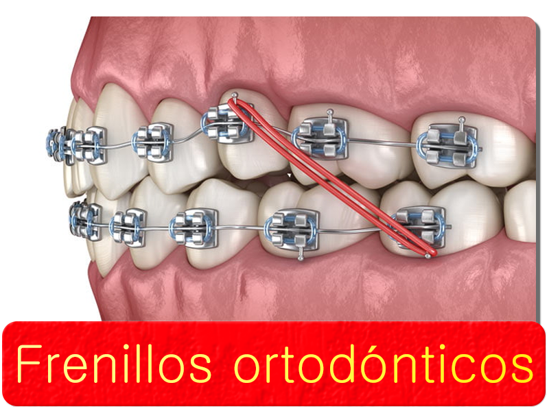 Frenillos ortodonticos