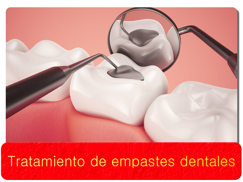 Tratamiento de empastes dentales