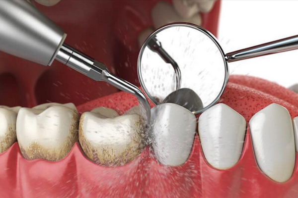 dental cleaning