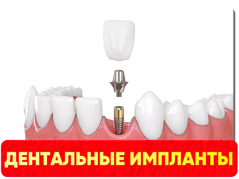ДЕНТАЛЬНЫЕ ИМПЛАНТЫ