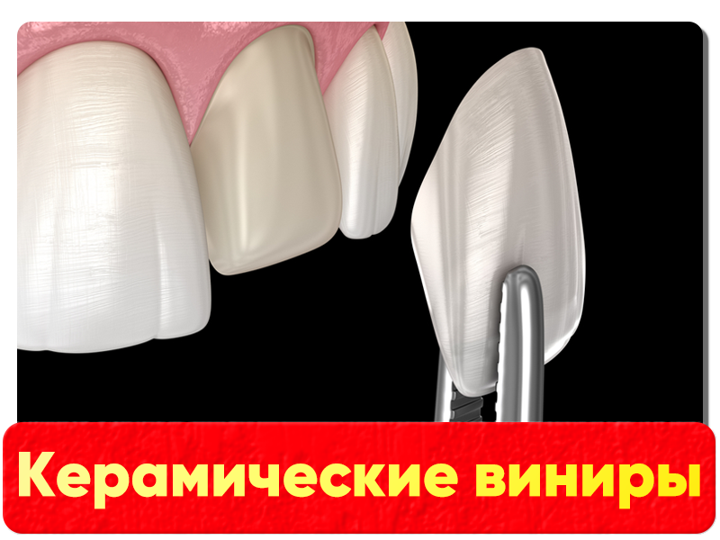 Керамические виниры