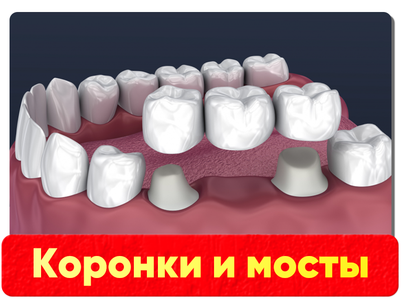 Коронки и мосты