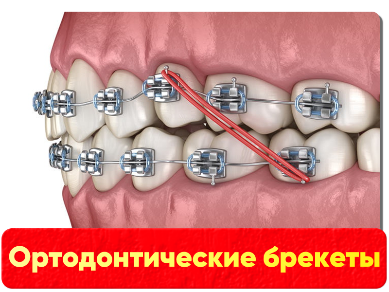 Ортодонтические брекеты