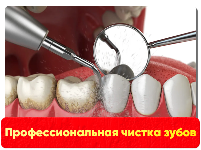 Профессиональная чистка зубов