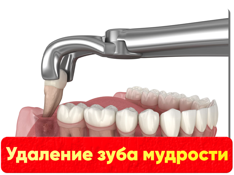 Удаление зуба мудрости