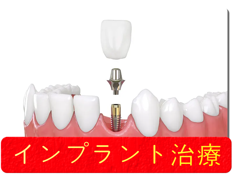 インプラント治療