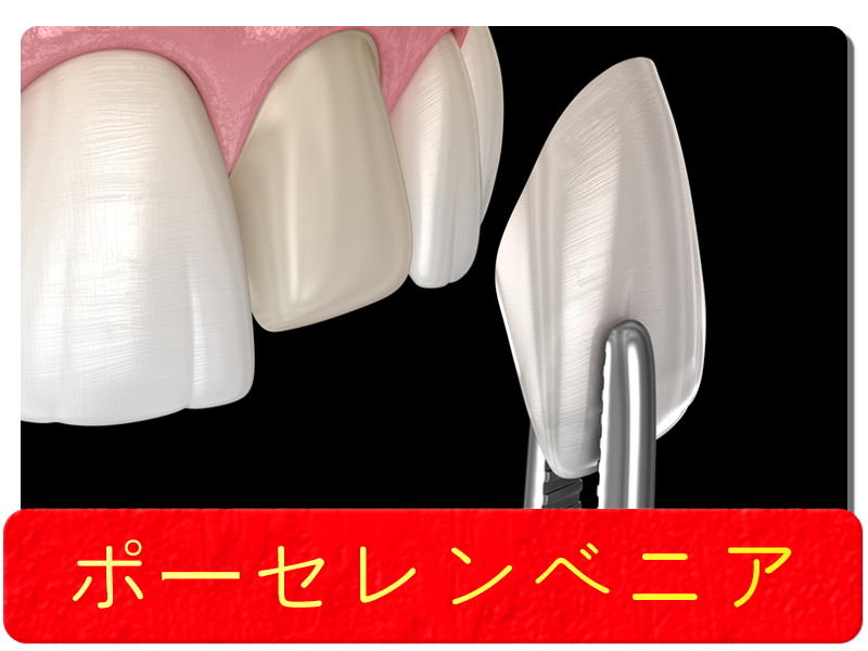 ポーセレンベニア