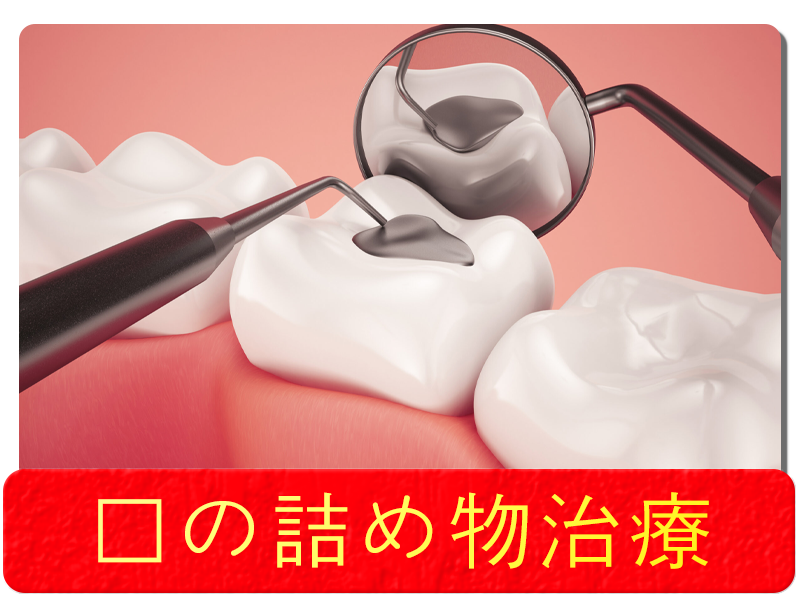 歯の詰め物治療