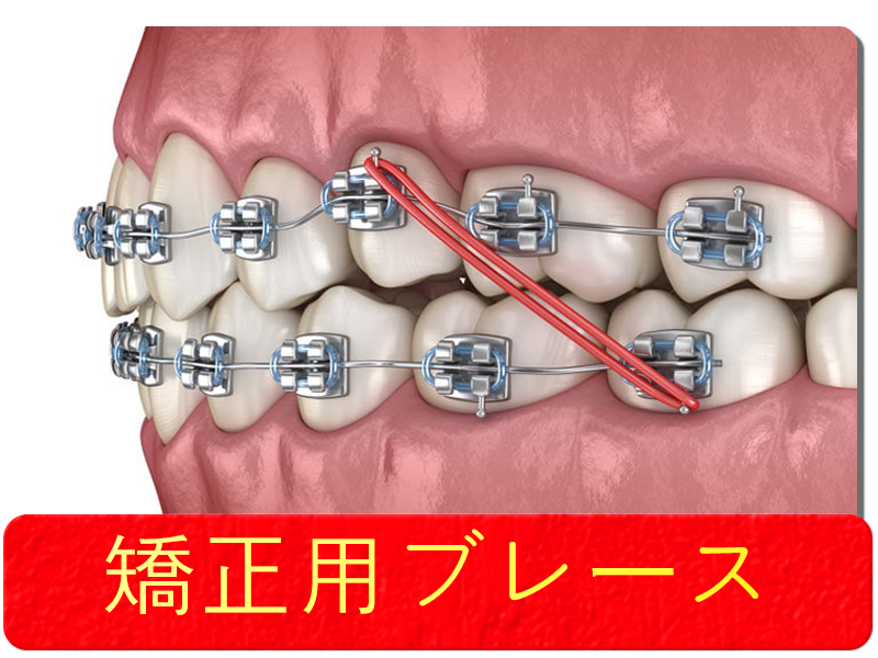 矯正用ブレース