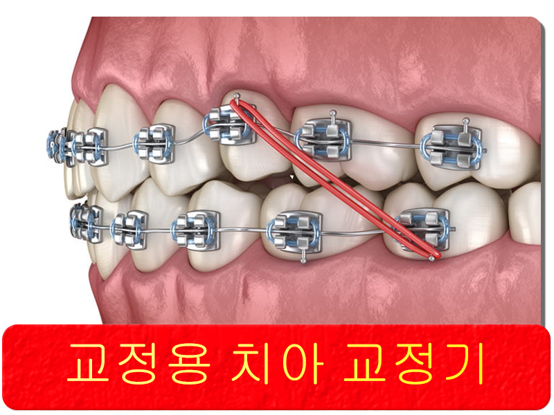 교정용 치아 교정기