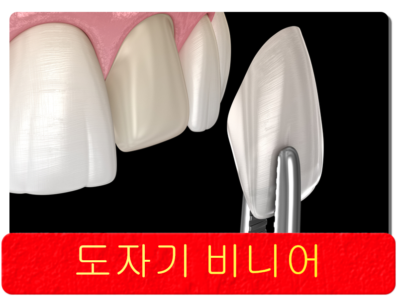 도자기 비니어