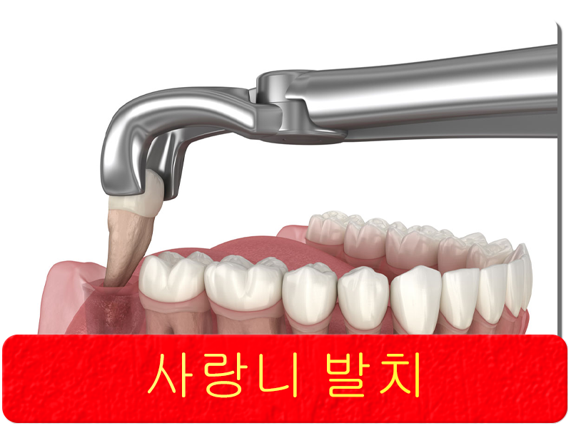 사랑니 발치