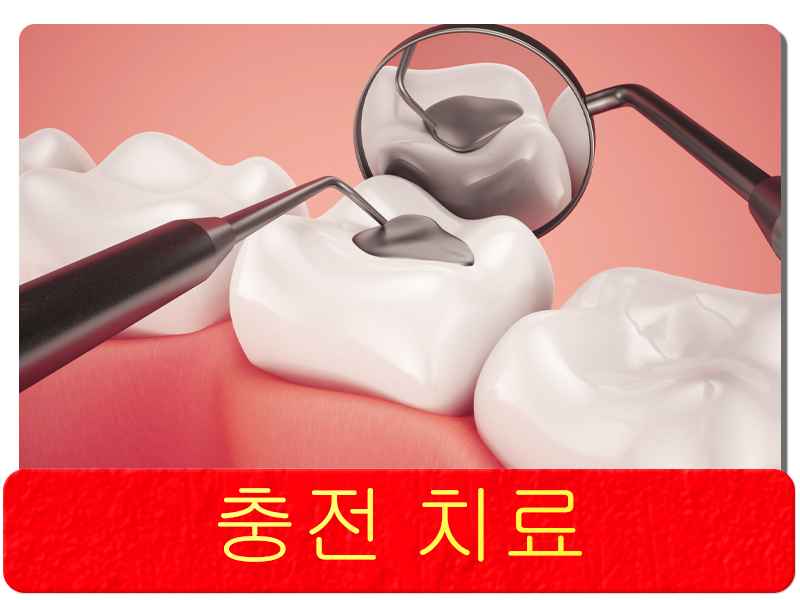충전 치료