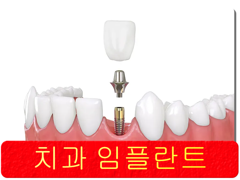 치과 임플란트