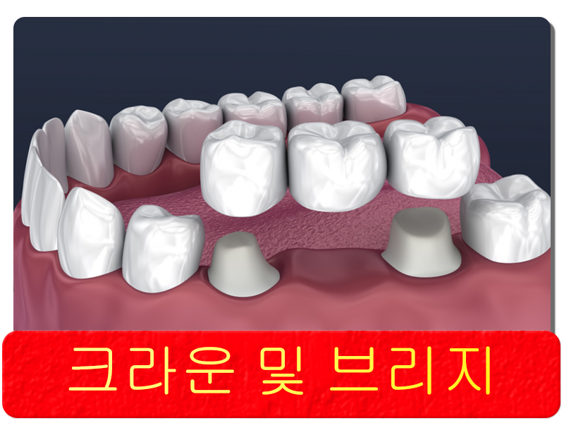 크라운 및 브리지
