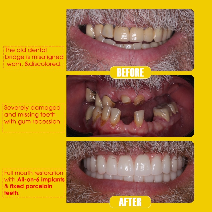 Physiological Rationales The limitations of conventional prosthetics